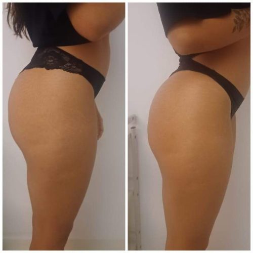 20 min de maderoterapia