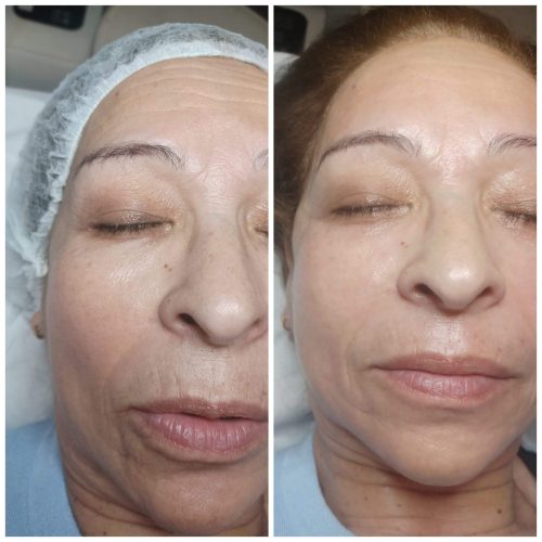 210224_fotorejuvenecimiento