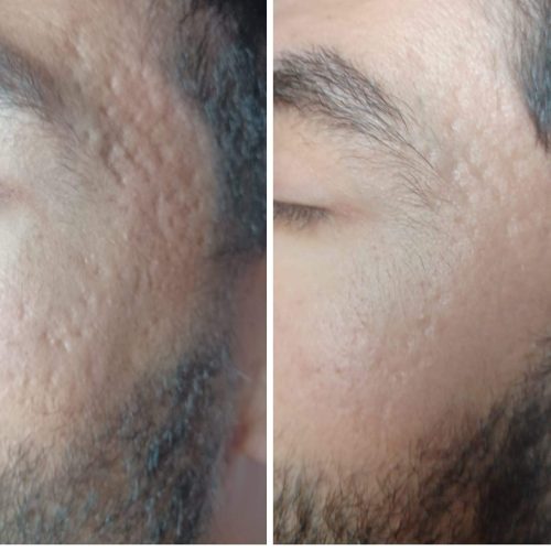 dermapen marcas acne