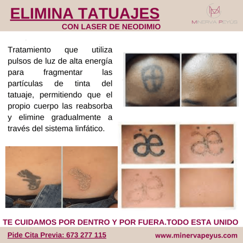 eliminacion tatuajes laser neodimio