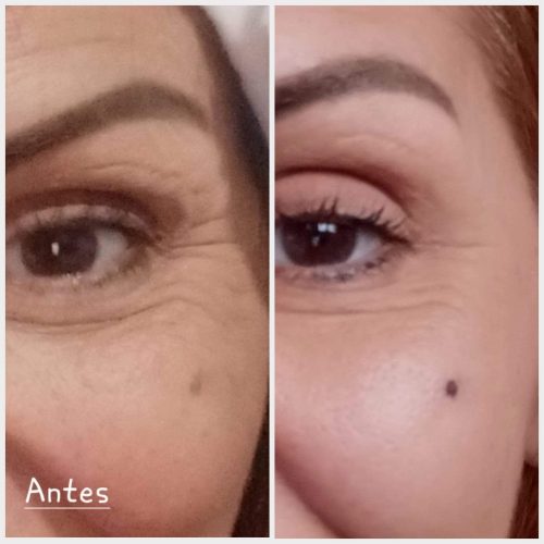 radiofrecuencia facial